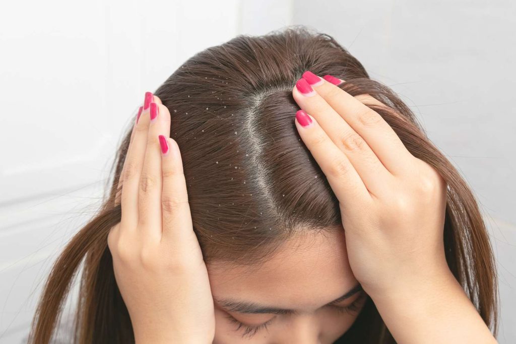 Discover the Power of Rosemary Oil for Dandruff-Free, Thick Hair