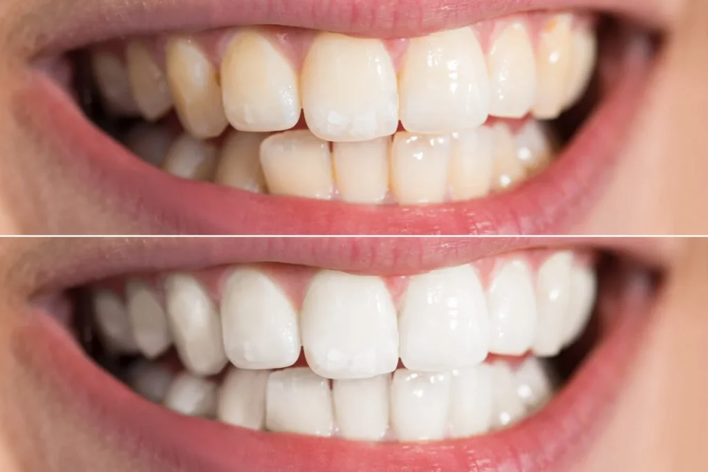 Teeth Whitening: What You Should Know Before Getting Started