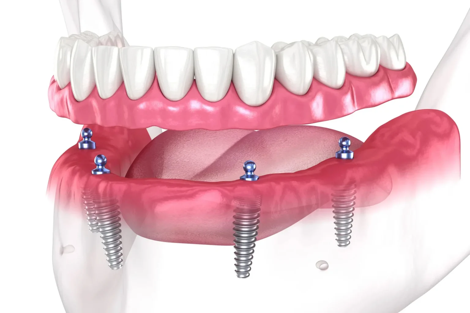 Permanent Solutions for Missing Teeth